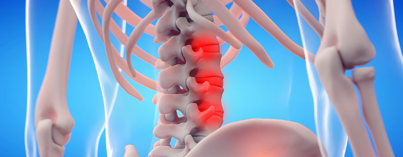 patient needing ankylosing spondylitis treatment in Monterey Park