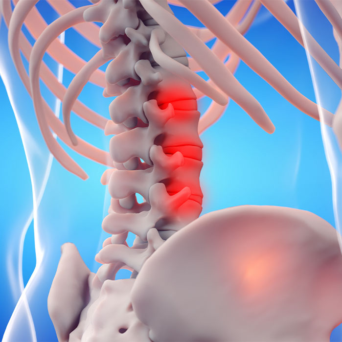 ankylosing spondylitis chiropractor in Monterey Park, CA