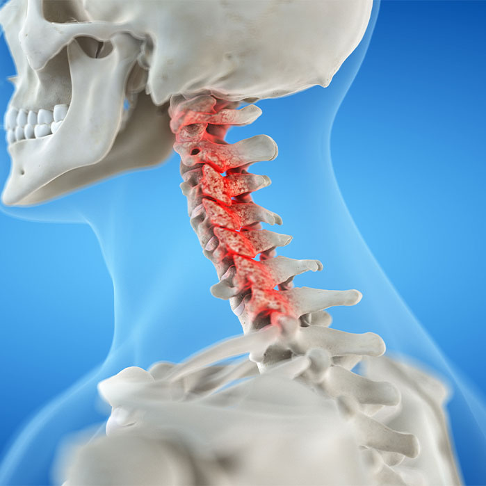 bone spur treatment in Monterey Park, CA