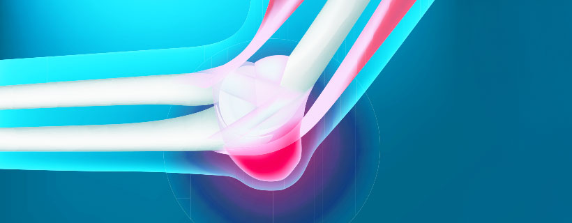 patient needing bursitis treatment in Monterey Park