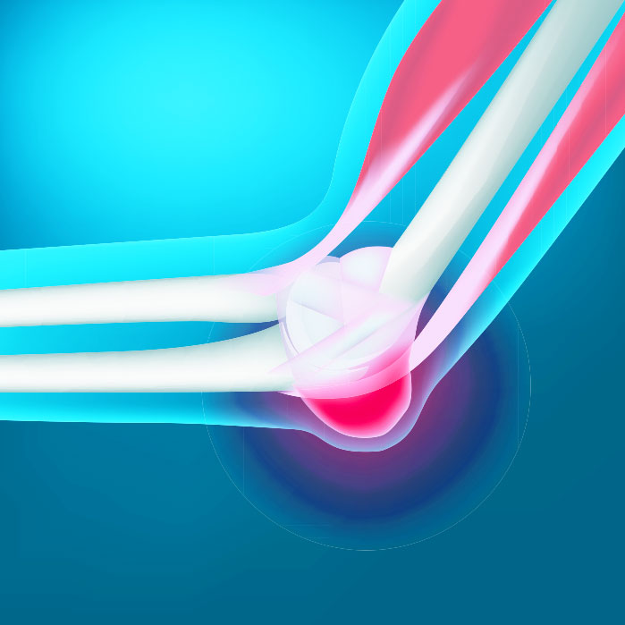 bursitis chiropractor in Monterey Park, CA