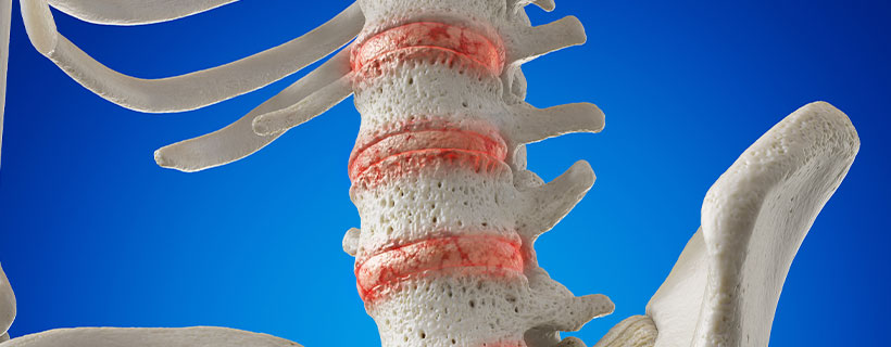 patient needing degenerative disc disease treatment in Monterey Park