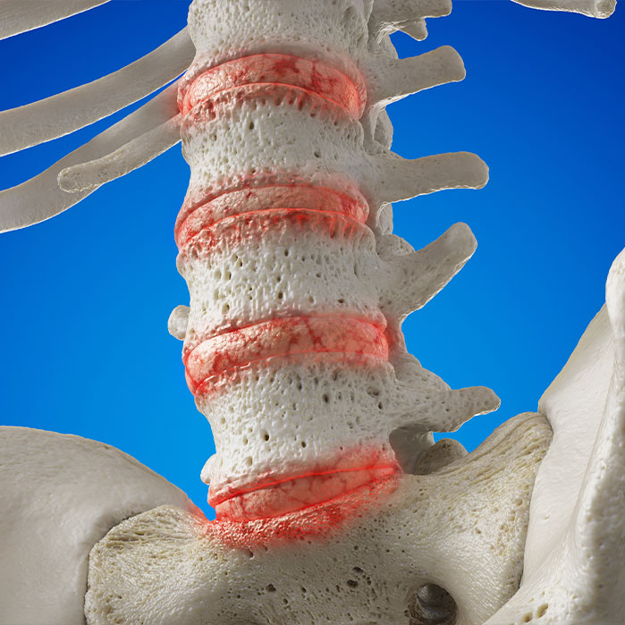 degenerative disc disease treatment in Monterey Park, CA