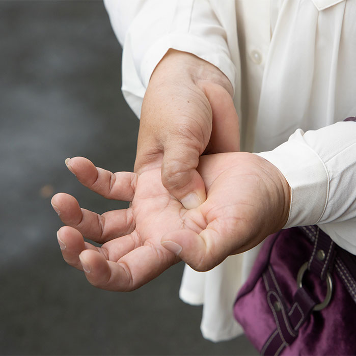 dupuytren contracture chiropractor in Monterey Park, CA