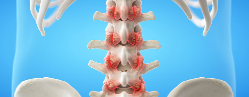 patient needing facet joint syndrome treatment in Monterey Park