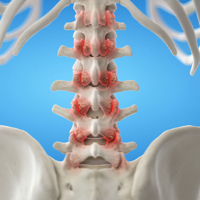 facet joint syndrome treatment in Monterey Park, CA