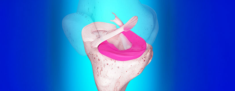 patient needing ligamentitis treatment in Monterey Park