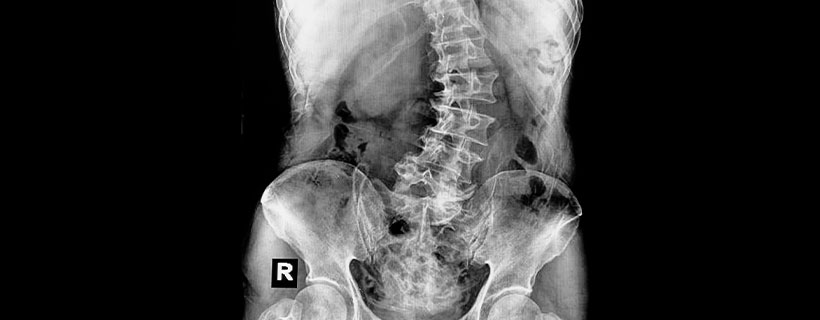 patient needing scoliosis treatment in Monterey Park