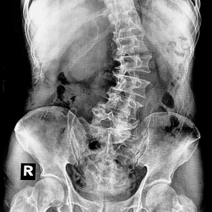 scoliosis chiropractor in Monterey Park, CA