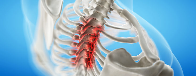 patient needing spinal stenosis treatment in Monterey Park