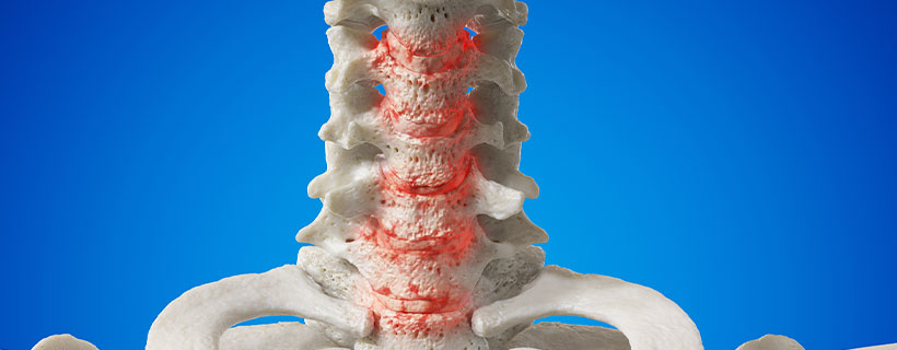 patient needing spondylosis treatment in Monterey Park