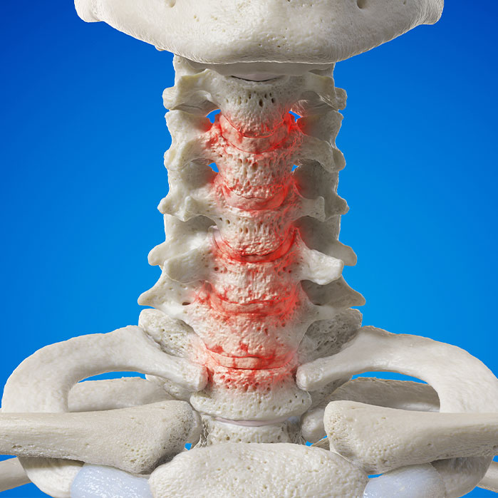 spondylosis treatment in Monterey Park, CA