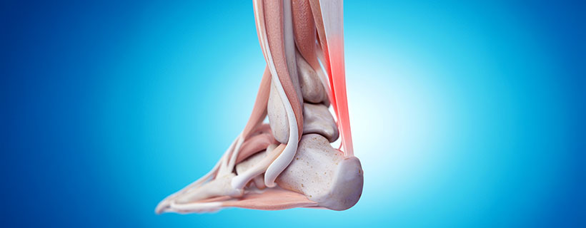 patient needing tendonitis treatment in Monterey Park