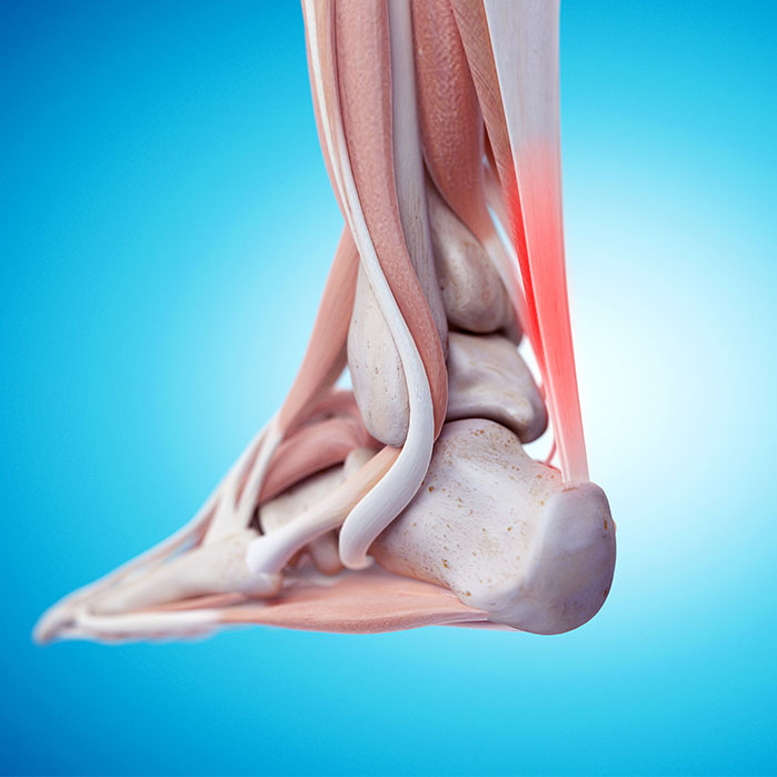 tendonitis chiropractor in Monterey Park, CA